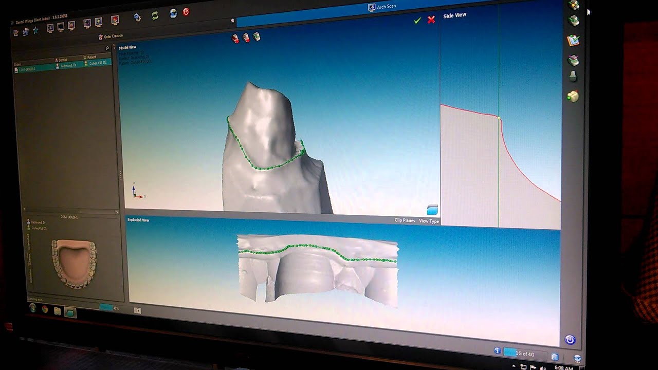 Creating a crown with a Dental Wings 3S scanner. YouTube