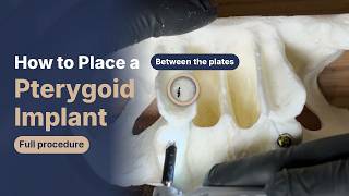 How to Place a Pterygoid Implant: Full Step-by-Step on a Model