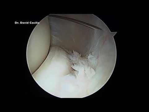 EPICONDILITIS. TRATAMIENTO ARTROSCÓPICO