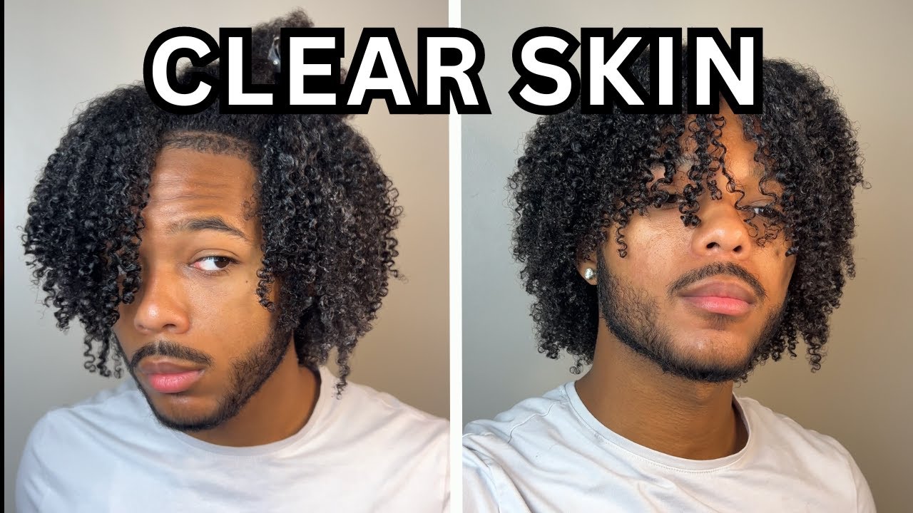 I tried to get clear skin in one week. And this happened... - YouTube