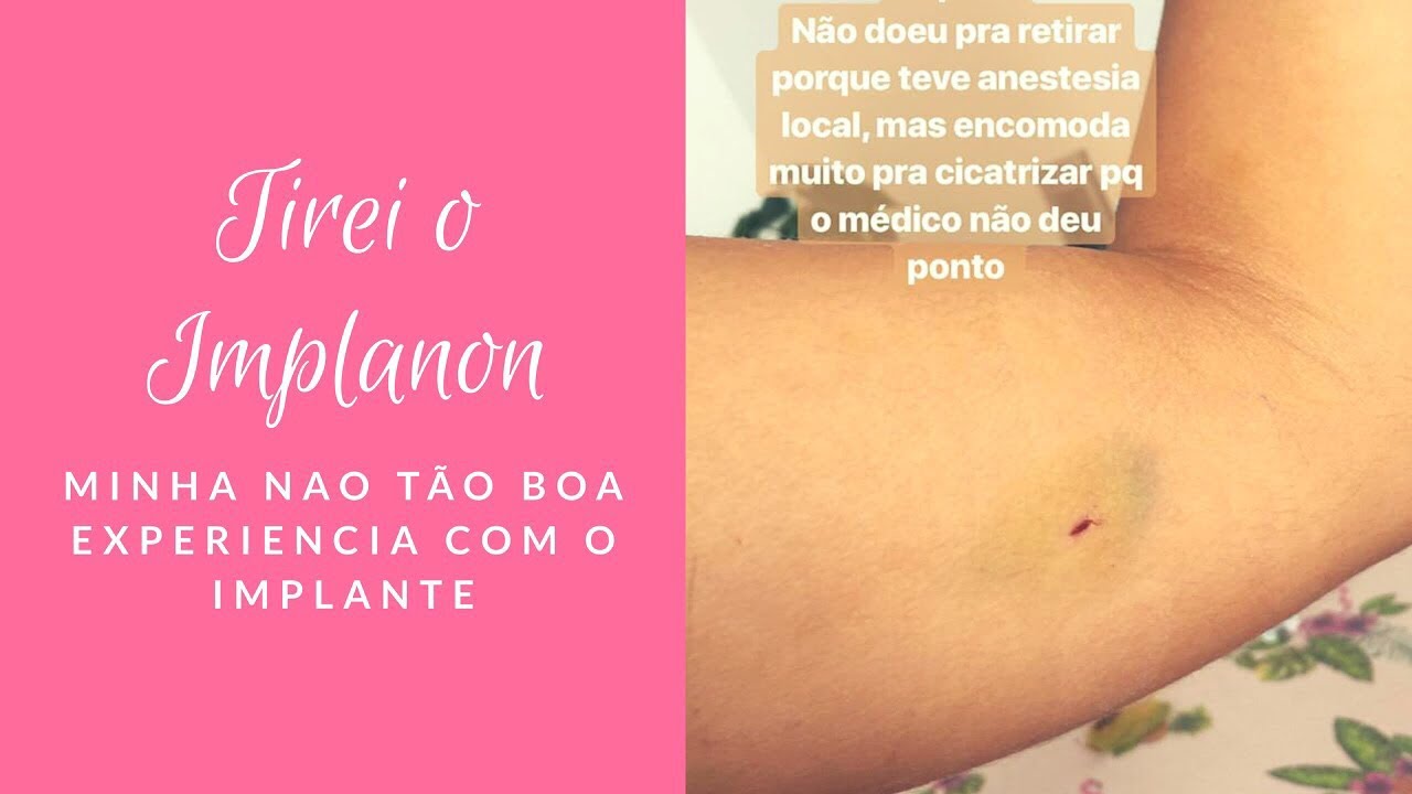 PRECISEI TIRAR O IMPLANTE: POR QUE E COMO FOI? *COMPLETO* - YouTube