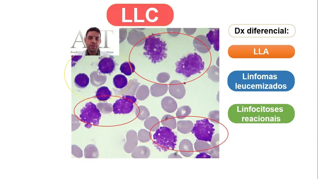 Manchas de Gumprecht na Leucemia Linfóide Crônica: O que são? Como relatar?