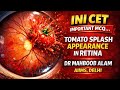 INICET IMPORTANT MCQ - Tomato Splash appearance in Retina - dr mahboob AIIMS #Retina #inicet2026 