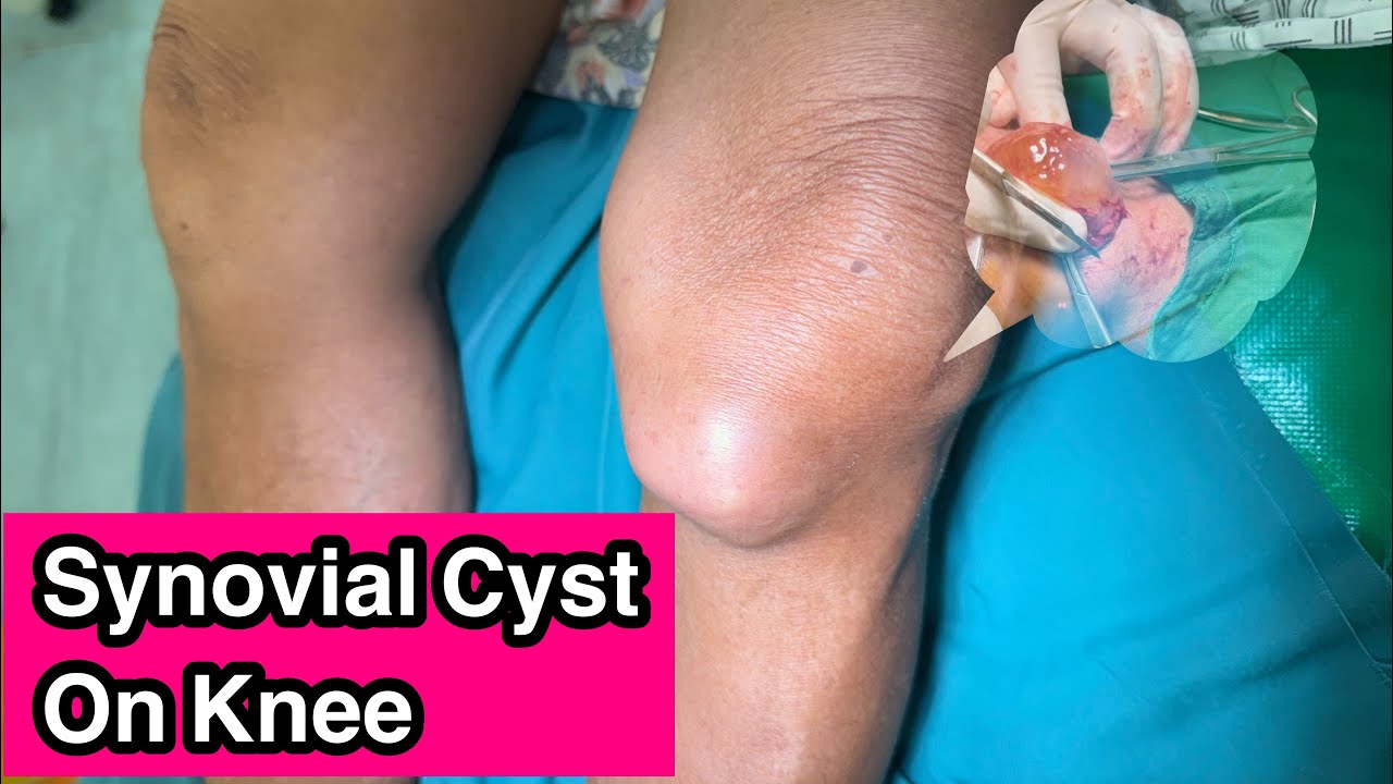 Ganglion Cyst On Knee Excision - YouTube