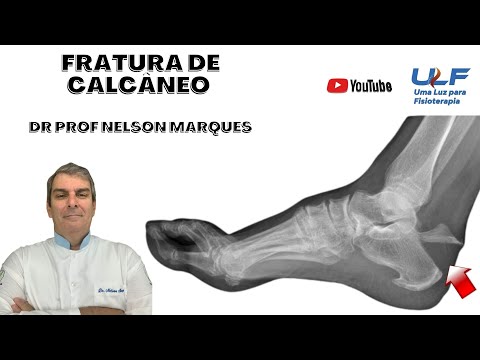 Vídeo: Meu calcanhar pode estar quebrado?