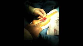 Achilles Tendon Rupture Repair Surgery | Houston Foot Surgeon