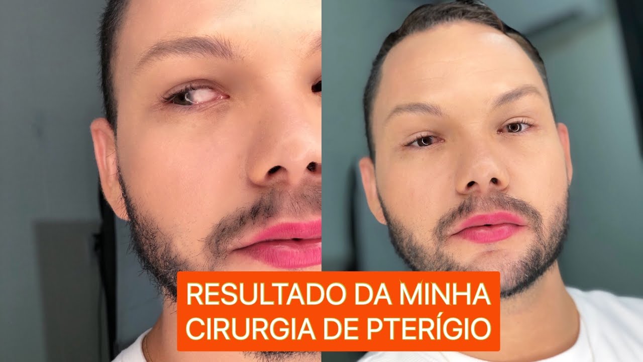 CIRURGIA DE PTERÍGIO MOSTREI RESULTADO DEPOIS DE 4 MESES POS CIRURGIA # ...