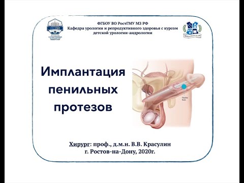 Фаллопротезирование В Москве Цены Отзывы И Фото