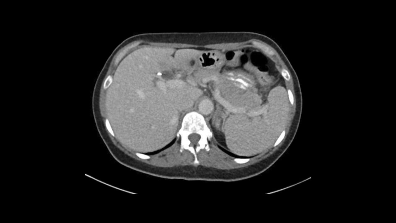 Confocal laser endomicroscopy to diagnose mucinous cystic neoplasms
