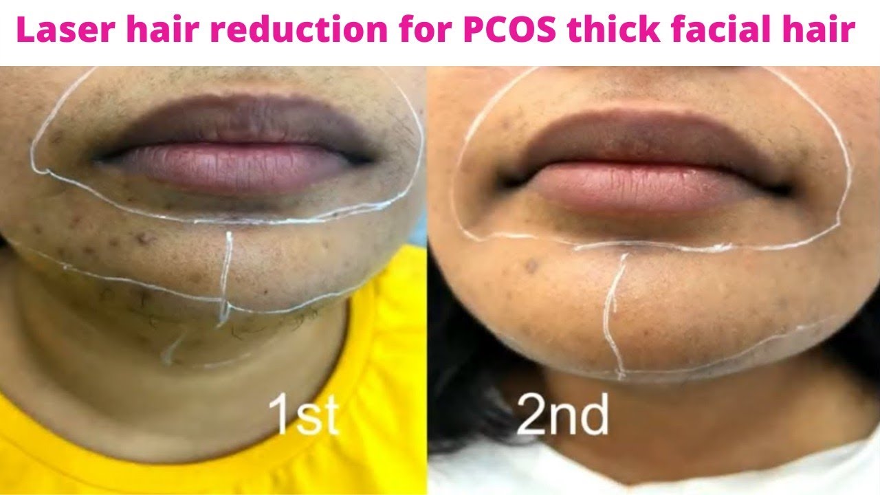 Laser Hair Session 2 Vlog PCOS Facial Hair Removal Face Laser 