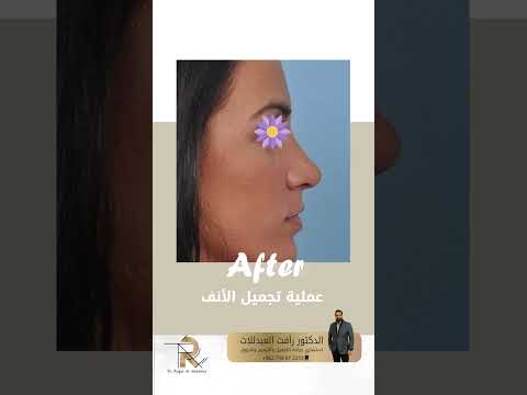 قبل و بعد صورة تجميل الانف لاحظ الفرق الكبير