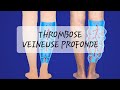 Tvp  thrombose veineuse profonde 