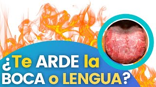 🔥¿Te ARDE la BOCA o la LENGUA? Síndrome de Boca Ardiente: TODO LO QUE DEBES SABER😱🔥