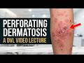 Perforating Dermatosis | Clinical Examination & Diagnosis