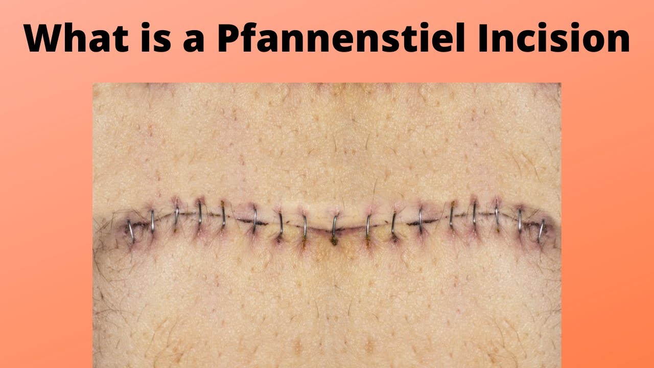 What is a Pfannenstiel Incision - YouTube