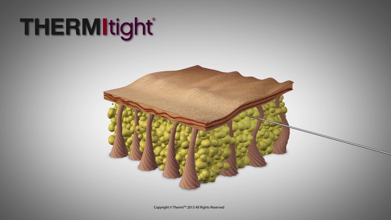 ThermiTight Injectable RF