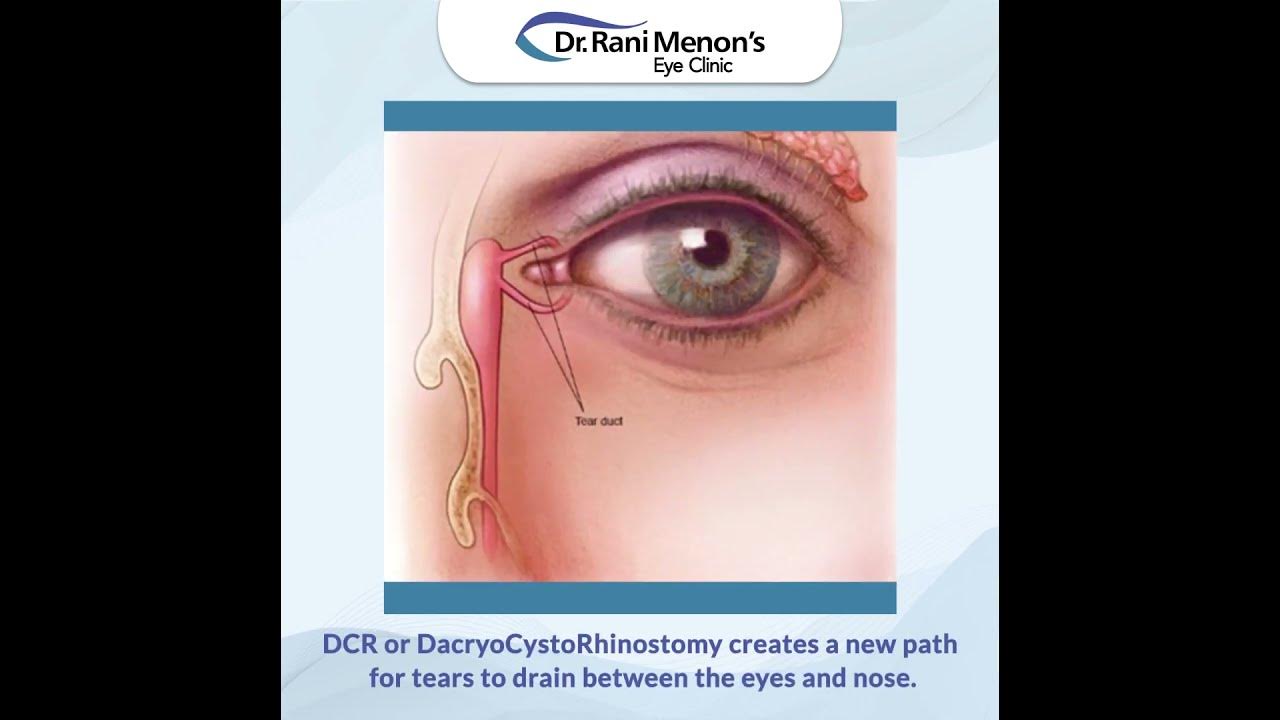What is DCR or DacryoCystoRhinostomy? YouTube