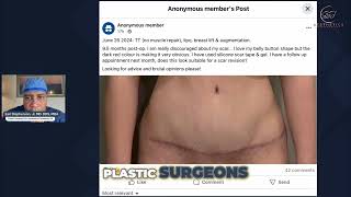 Stop the Bullying: Speak Up After Plastic Surgery