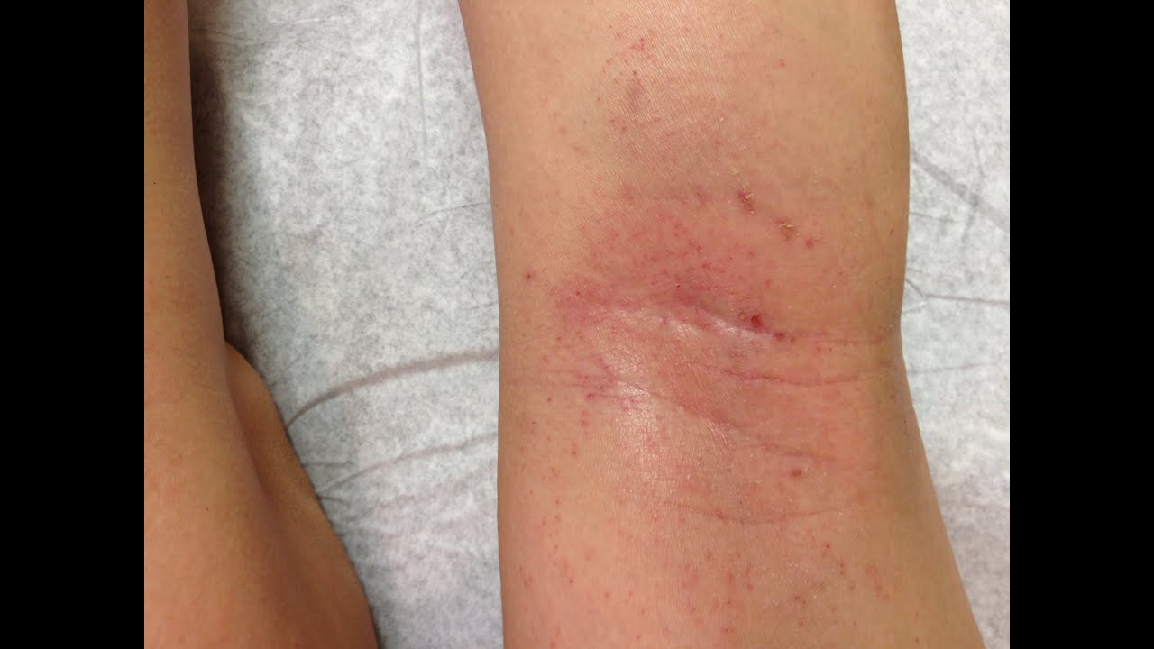 Beating My 6 Year-old's Eczema 