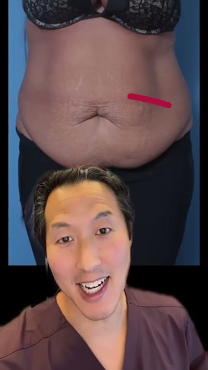Watch This Tummy Transformation! #shorts #tummytuck