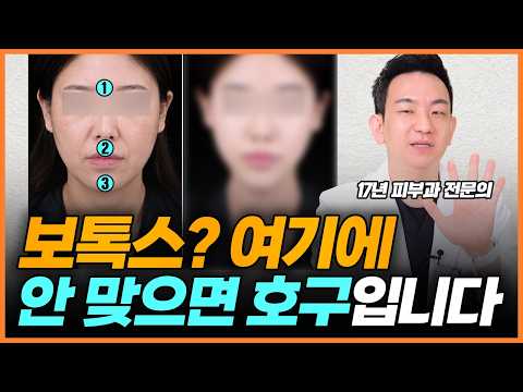 You need to get three Botox spots for your younger face ❗ A doctor of 17 years tells you