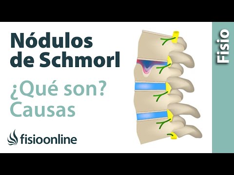 Vídeo: Hernia De Schmorl: Signos, Tratamiento, Causas, Formas, Diagnóstico