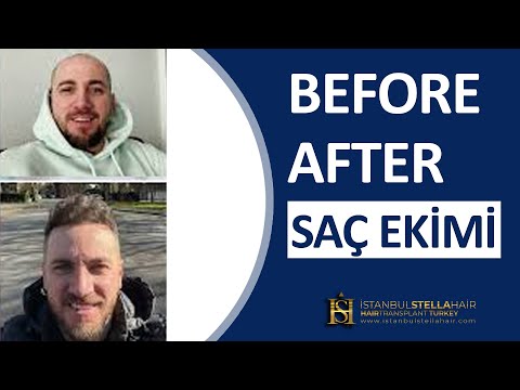 Before and After