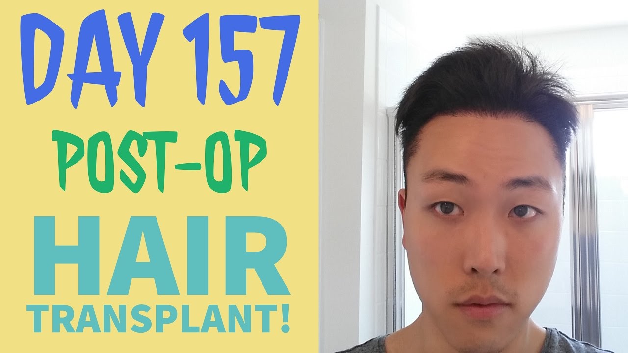 bpc 157 hair transplant New growth (crown) from injection : r/bpc_157 7 day post transplant update