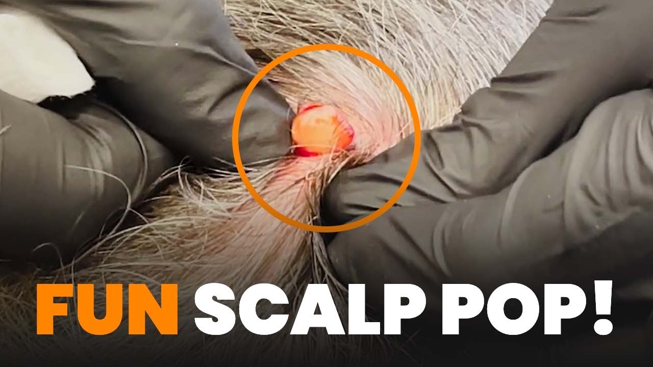 Fun Scalp Pop Youtube