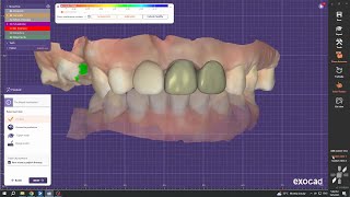 Exocad Cantilever Bridge Design For Zirconia Restoration on Tooth 21,22