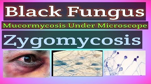 Black Fungus ||Mucormycosis || Zygomycosis Under Microscope ||E-Learn with Technologist