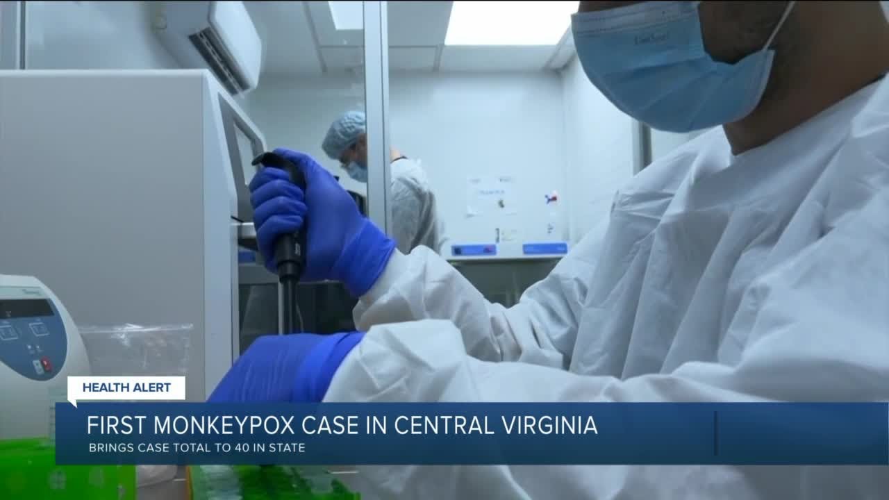 After monkeypox diagnosis in Central Virginia, doctor urges people to know signs, symptoms