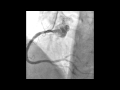 Medvid04angiogram catheter 20100930  cornary intervention rca 02mov