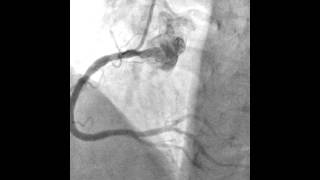 MedVid04_Angiogram Catheter 20100930 - Cornary Intervention RCA 02.mov