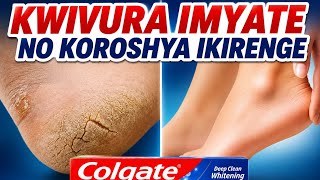 Uburyo Wagira Ikirenge Cyoroshye No Kwivura Imyate