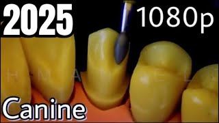 All Ceramic Crown Preparation for Maxillary Canine screenshot 5