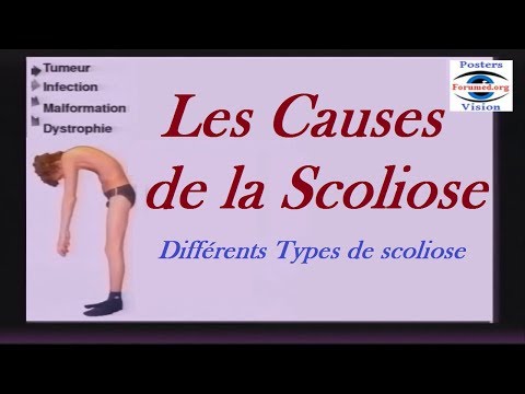 Vidéo: Scoliose Grade 3 - Caractéristiques, Symptômes Et Traitement