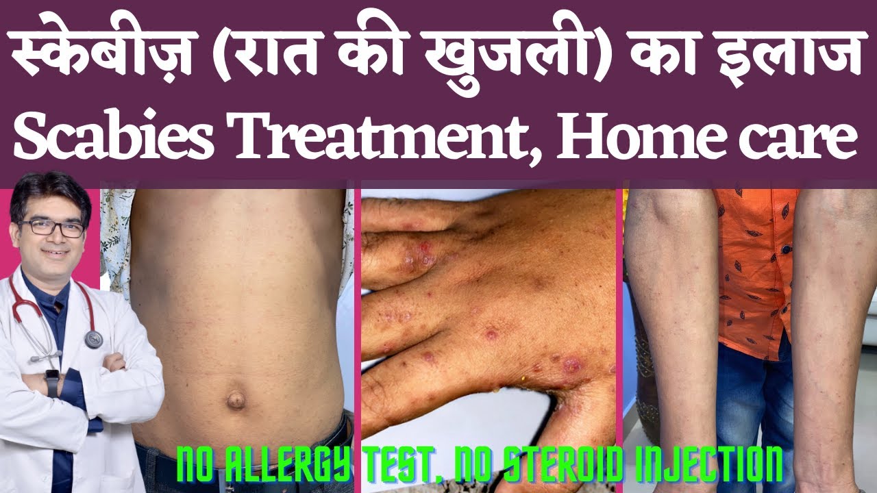 Scabies Treatment, Causes, Symptoms In Hindi | स्केबीज़ का इलाज, कारण, लक्षण | रात की खुजली
