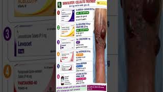 Skin blister treatment in hindi #celulitis