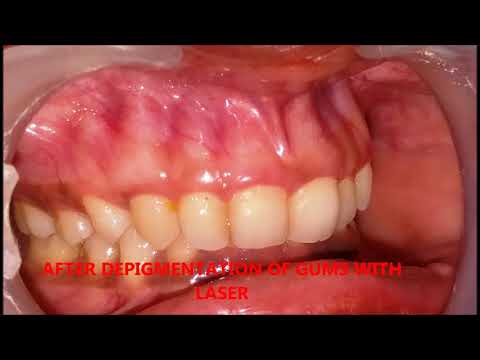LASER GUM DEPIGMENTATION