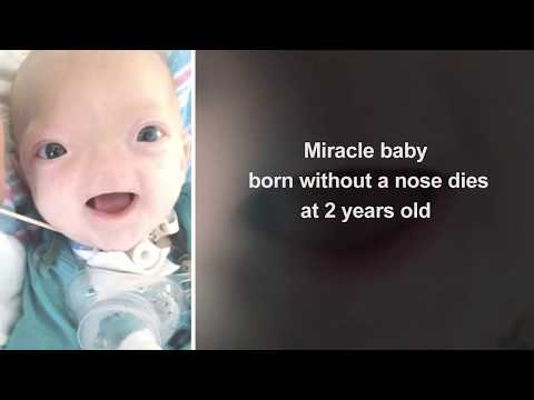 Video: The 2-year-old Boy Without A Nose Died