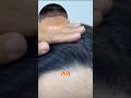 Rate This Hairline Hair Transplant 1-10 #femalehairtransplant #bhiclinic