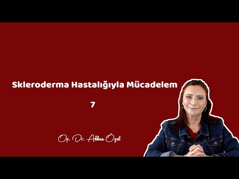 SKLERODERMA HASTALIĞIYLA MÜCADELEM 7 - Op. Dr. Akben Özel