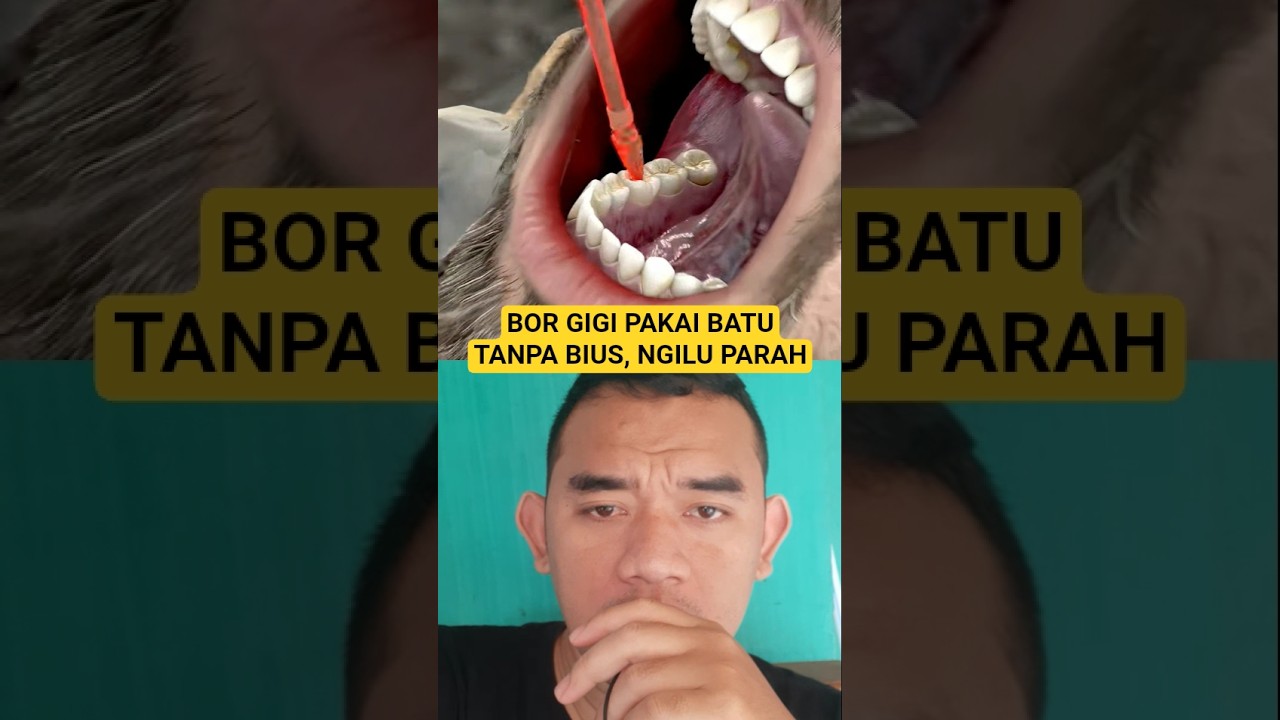 Perawatan Gigi Zaman Dulu Dibor Pakai Batu Tanpa Bius… NGILU!” 