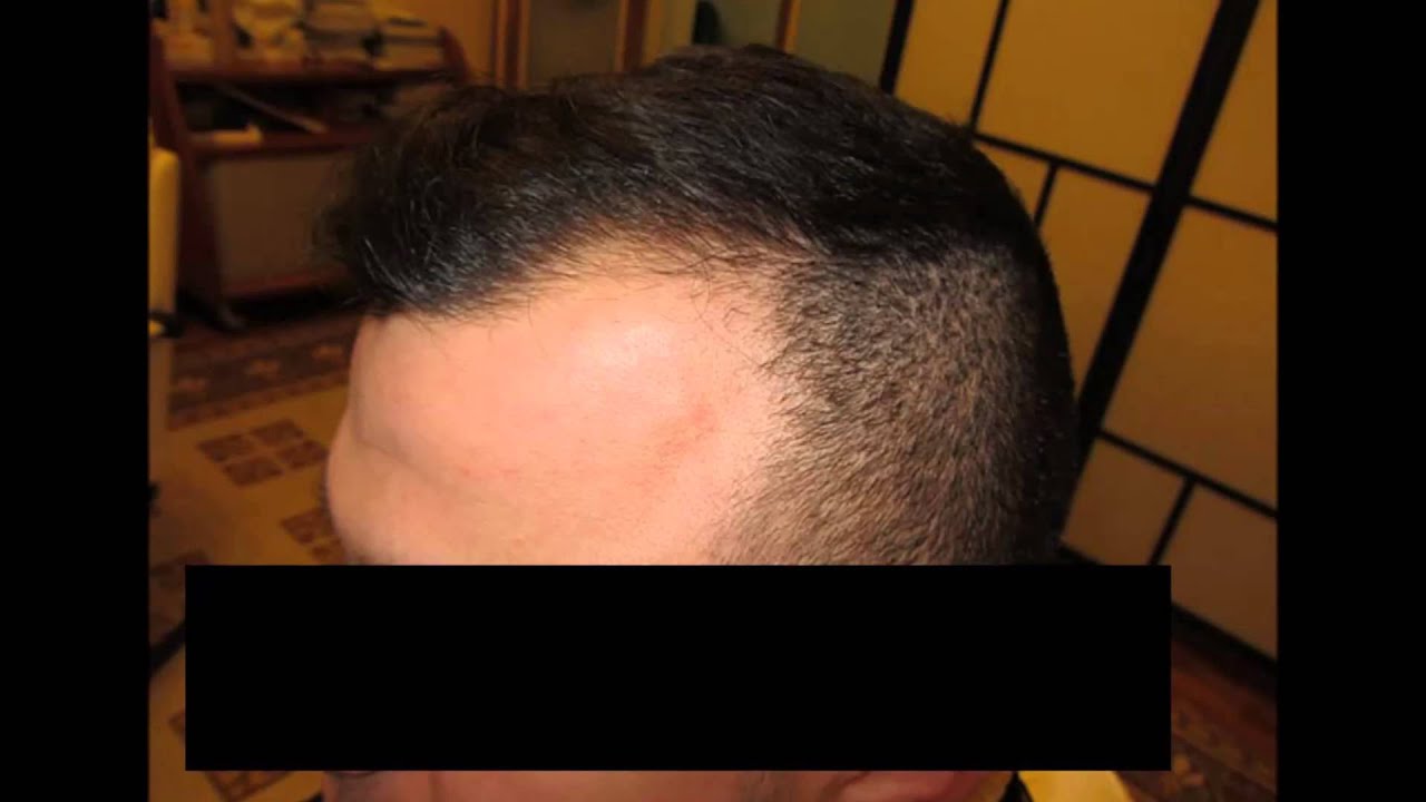 Trapianto Capelli FUE (24 anni 1100 UF in Unica Seduta)