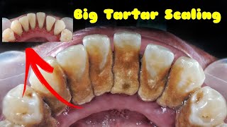 Big Tartar | SCALING | Dentist | Dokter Gigi_Ruliyanto