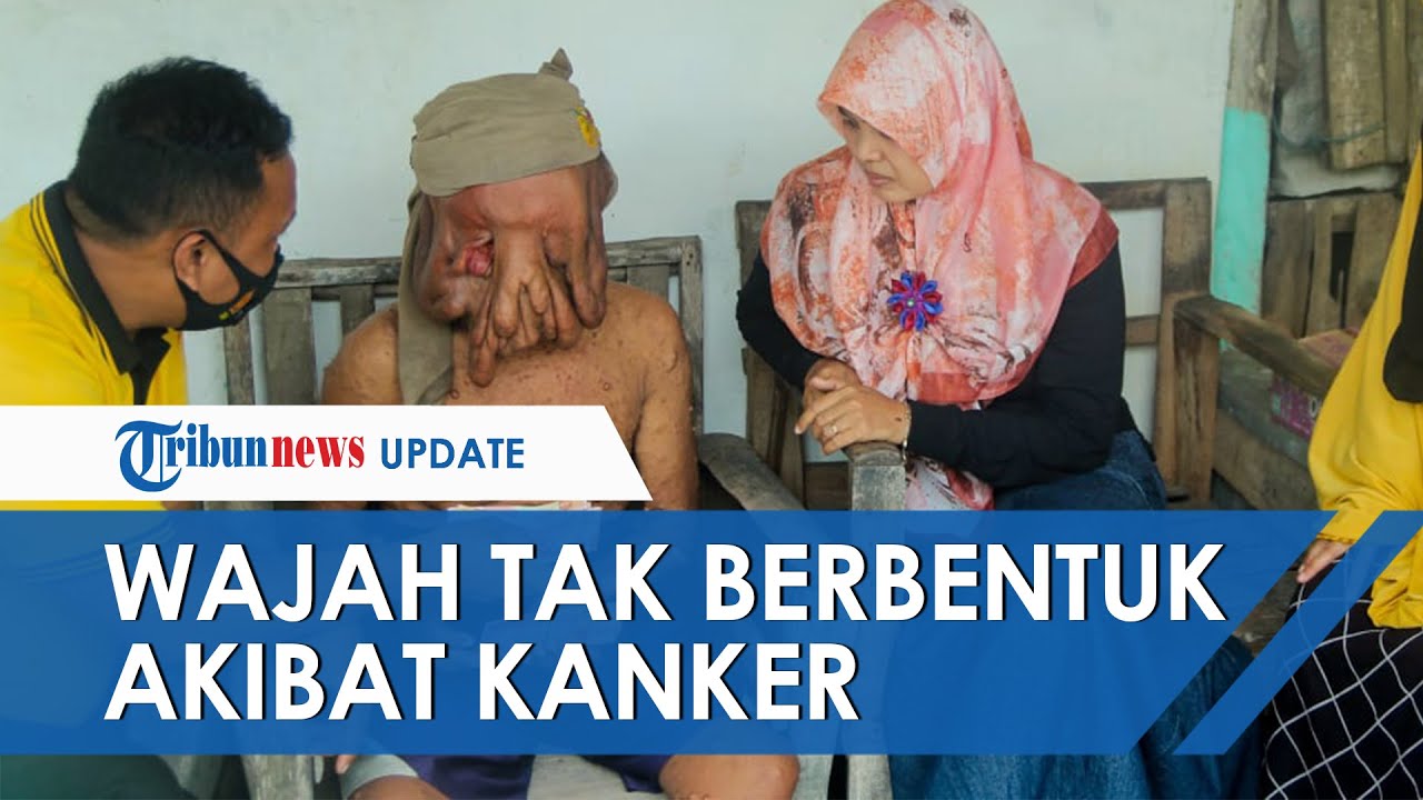 Wajah Tak Berbentuk Akibat Alami Kanker hingga Tak Bisa Melihat, Pria  Nganjuk Ini Hidup Sebatangkara - YouTube