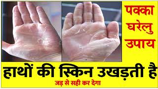 Health हाथों की स्किन उखड़ती है तो ये घरेलु उपाय Tips for You facts- home remedies for skin peeling screenshot 2