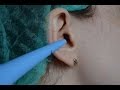 Серная пробка. Удаление  в домашних условиях. Ear wax  Removal at home