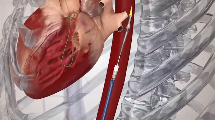 Zoom Webinar: Transcatheter Aortic Valve Replacement | NCH Healthcare System - DayDayNews